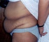 Tummy Tuck