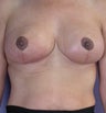 Breast Lift
