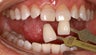 Teeth Whitening
