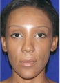 Ethnic Rhinoplasty