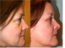 Upper and Lower Blepharoplasty (eyelid lift)