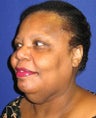 Face Lift, Neck Lift, Neck Liposuction