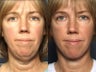 Facelift