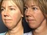Facelift
