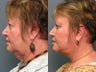 Brow Lift