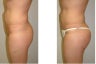 Buttock Augmentation