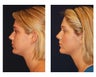Fat Grafting / Chin Lipo