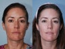 Cosmion Mask and M2 Treatment of Melasma