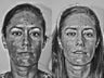 Cosmion Mask and M2 Treatment of Melasma