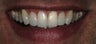 Cosmetic Bonding and gumlift