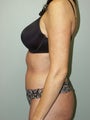 Liposuction