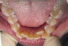 Invisalign