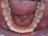 Invisalign