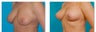 Breast Lift/Mastopexy