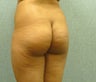 Brazilian Butt Lift