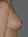 Breast Lift