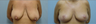 Breast Lift