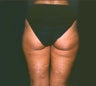 Smartlipo