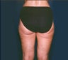 Smartlipo