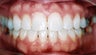 Orthodontic braces with miniscrew support to close openbite