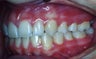 Orthodontic braces to correct a Class II malocclusion