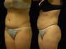 Smartlipo MPX abdomen, waist and flanks