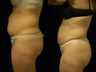 Smartlipo MPX abdomen, waist and flanks