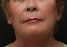 Fat Transfer to Face