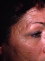 Acne Scarring