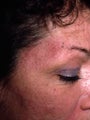 Acne Scarring