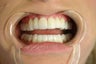 smile make over