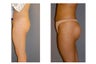 Buttock Implant Augmentation