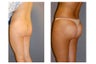 Buttock Implant Augmentation