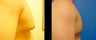 Male Breast Reconstruction