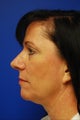 Nose Surgery/Rhinoplasty
