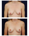 Breast Lift