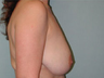Breast Lift