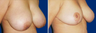 Breast Lift