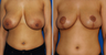 Breast Lift