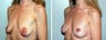 Breast Lift