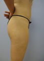 Liposuction
