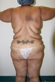Brazilian Butt Lift