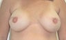 Breast Reconstruction