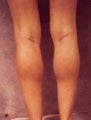 Women's Calf Augmentation