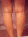 Women's Calf Augmentation
