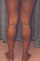 Women's Calf Augmentation