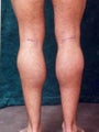 Men's Calf Augmentation