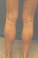 Men's Calf Augmentation
