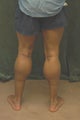 Men's Calf Augmentation