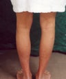 Men's Calf Augmentation